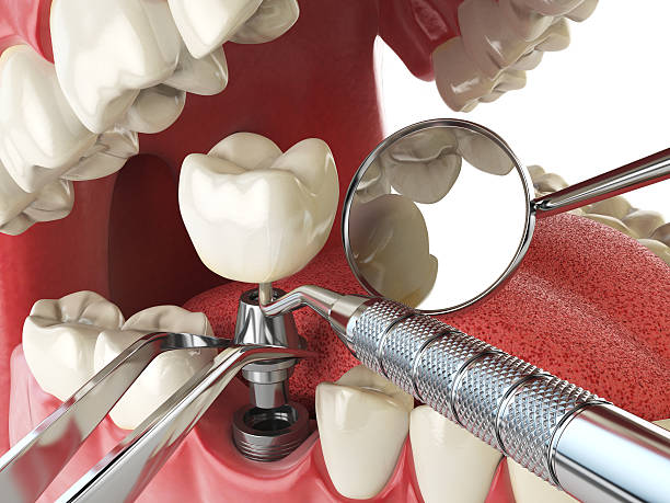 Best Emergency Dental Care for Sports Injuries in Fulton, MD